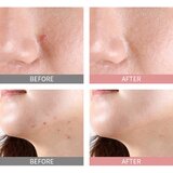 Mizon Good Bye Blemish Pink Spot serum s puderom za lokalnu primjenu protiv akni 19 ml | shoptok.hr