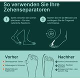 YOGAMEDIC silikonski razpiralci prstov za korekcijo hallux valgus - komplet 6 kosov | Shoptok.si