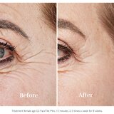 Silkn FaceTite Mini uređaj za zaglađivanje i smanjenje bora oko očiju i usana + gel 1 kom | shoptok.hr