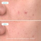 Novexpert Clear Skin piling serum – Dupla obnova za čist ten, manje nesavršenosti i anti-age efekat | Eponuda.com