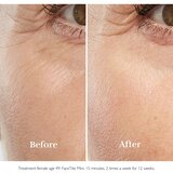 Silkn FaceTite Mini uređaj za zaglađivanje i smanjenje bora oko očiju i usana + gel 1 kom | shoptok.hr