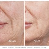 Silkn FaceTite Prestige naprava za glajenje in odpravo gub | Shoptok.si