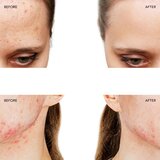 Foreo ESPADA™ 2 pero z modro lučko za pomirjenje pojava aken Fuchsia 1 kos | Shoptok.si