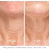 Silkn FaceTite Prestige uređaj za zaglađivanje i smanjenje bora | shoptok.hr