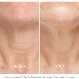 Silkn FaceTite Essential uređaj za zaglađivanje i smanjenje bora | shoptok.hr