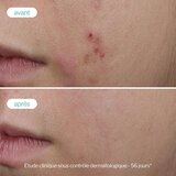 Novexpert Trio-Cink Booster Serum – Serum protiv bubuljica, akni i nepravilnosti | Eponuda.com