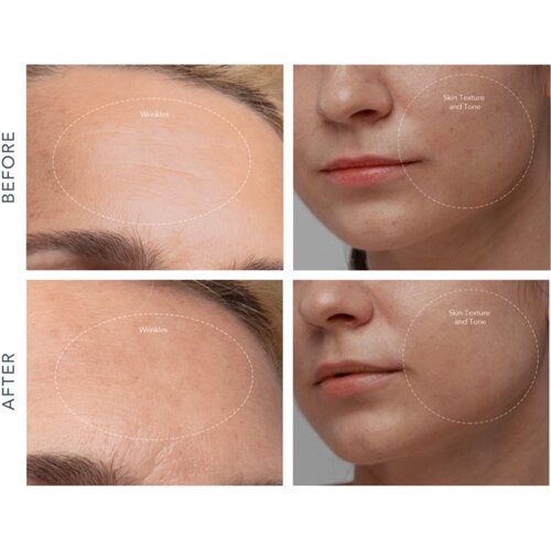 Foreo KIWI&amp;trade; Derma naprava za diamantno mikrodermabrazijo in či&amp;scaron;čenje por 1 kos Slike