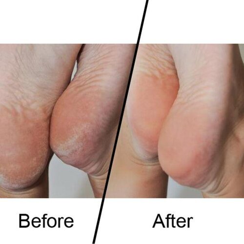  Emjoi MICRO-Pedi brusilnik za pete + DARILO Slike